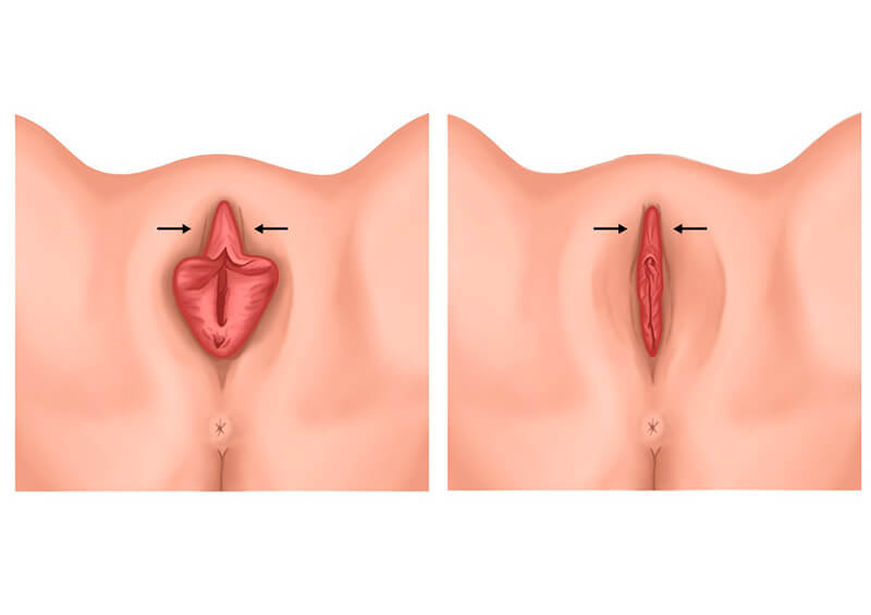 Exemplo de ninfoplastia a laser com redução também do excesso de pele do clitóris fotos antes depois